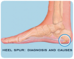 خار پاشنه (Heel Spur)؛ علل، علائم و راههای درمان