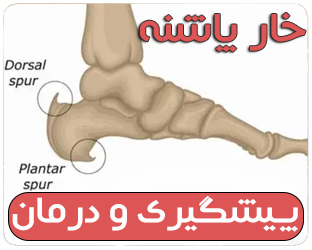 از قدم‌های دردناک تا راه رفتن آرام: هر آنچه باید درباره «خار پاشنه» بدانید